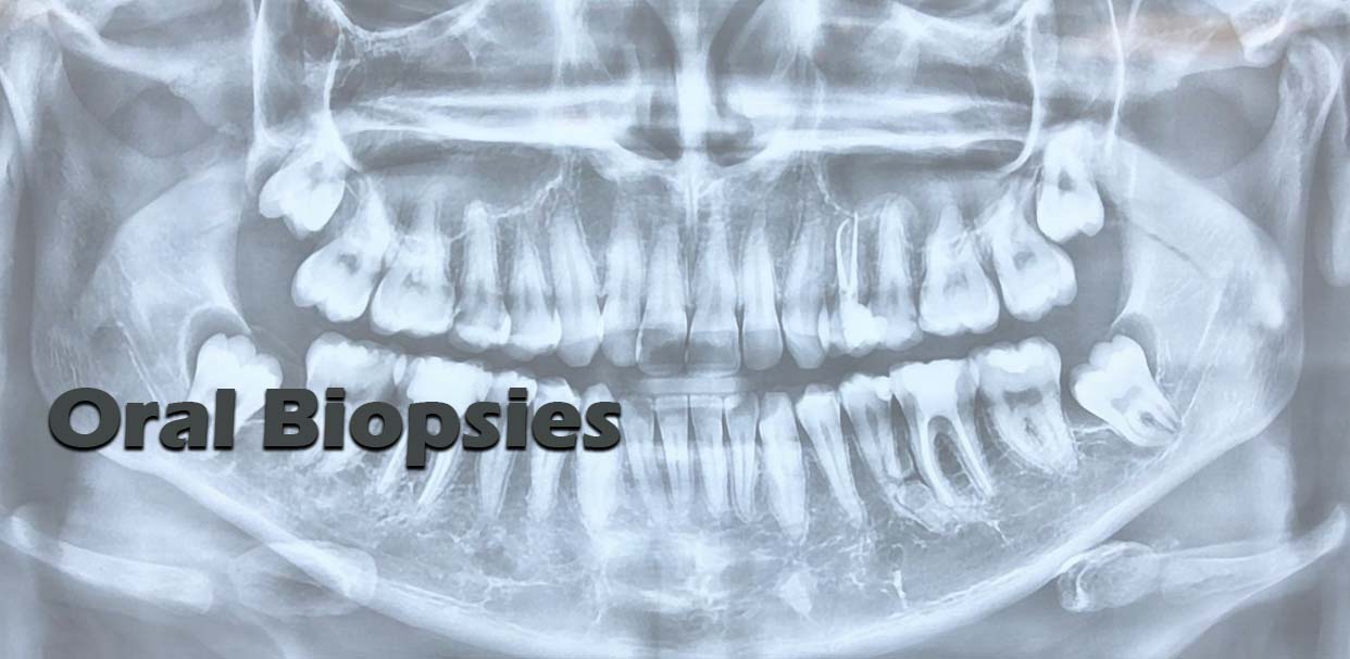 Oral Biopsies